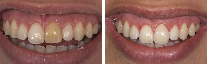 Tooth color correction