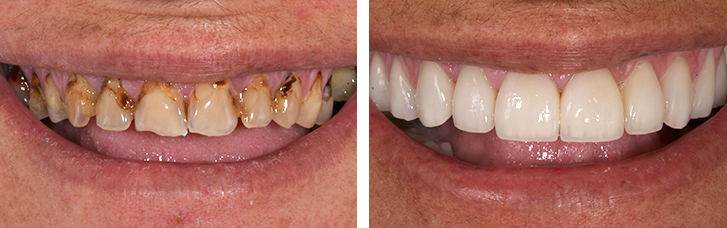 Crowns: reconstruction of teeth and smile