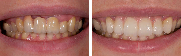 Gum bridge dental prosthesis