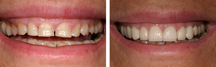 Reconstrucción de dientes y sonrisa
