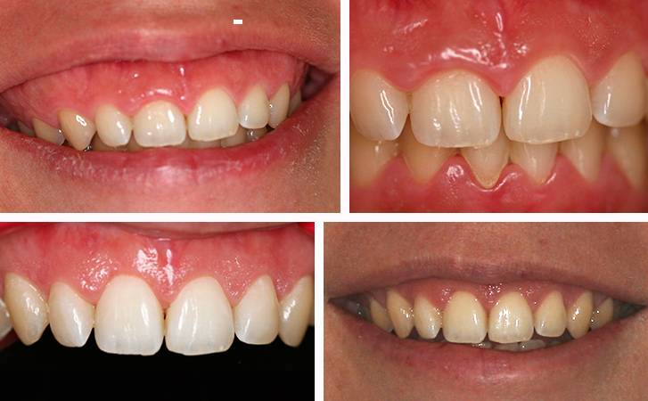 Treatment for gingival smile