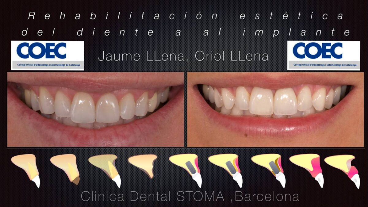 Rehabilitació estètica de la dent a l'implant