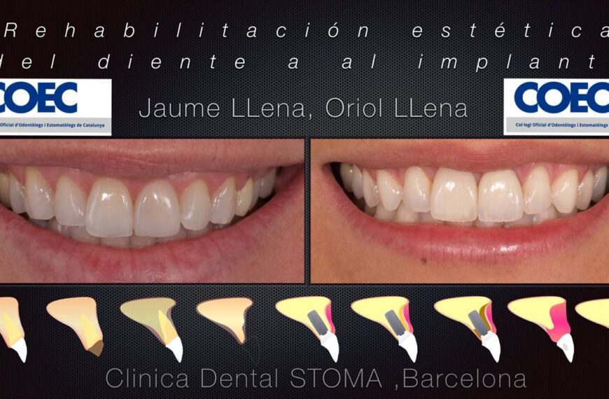 Rehabilitació estètica de la dent a l'implant